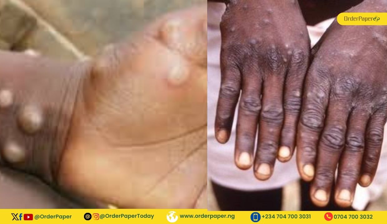 Reps decry rising Mpox epidemic in Nigeria