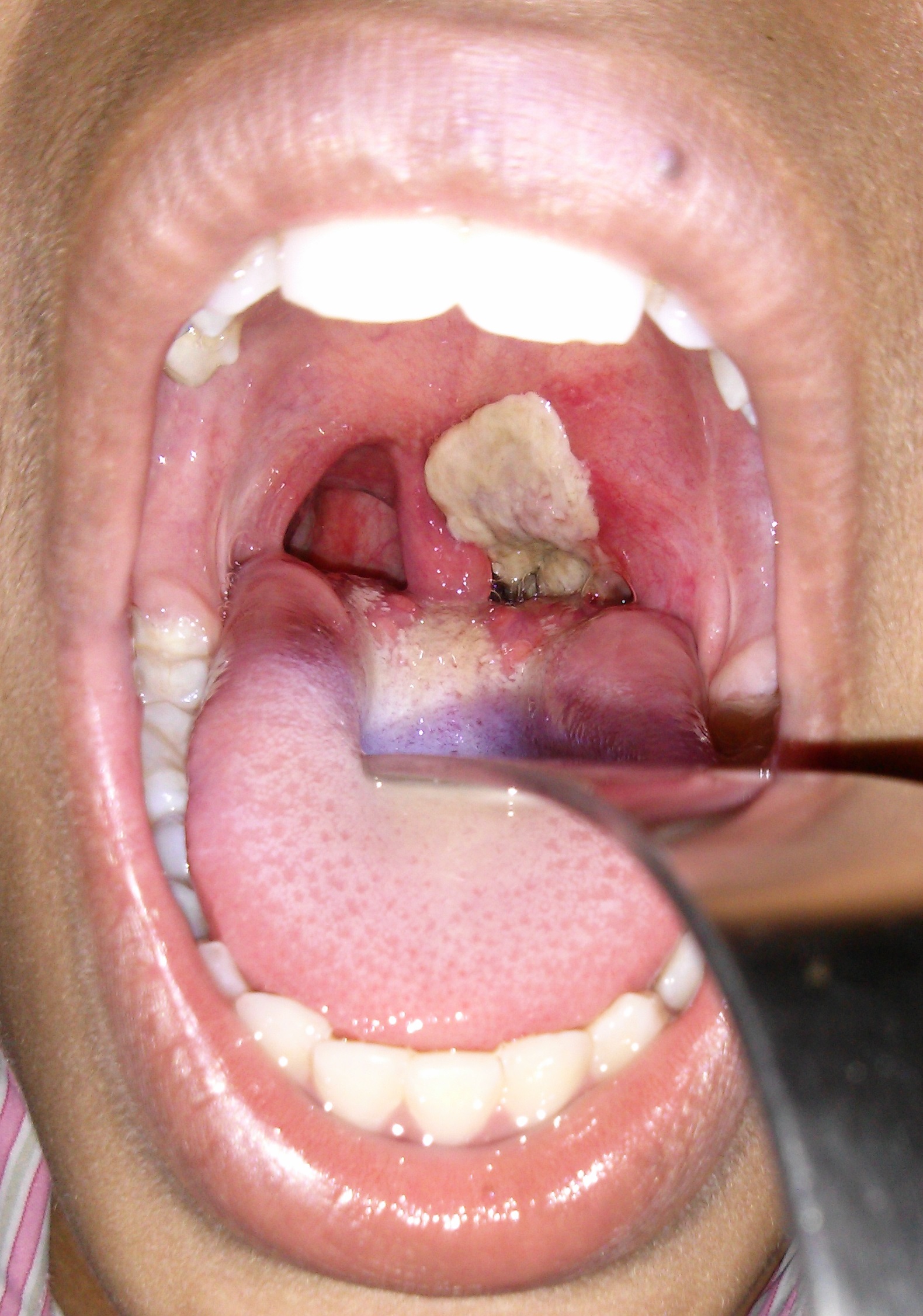 Diphtheria outbreak